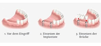 Wurzelbehandlung , Zahnarzt Penteke, Zahnpraxis, Zahnbehandlung, Zahnchirurgie